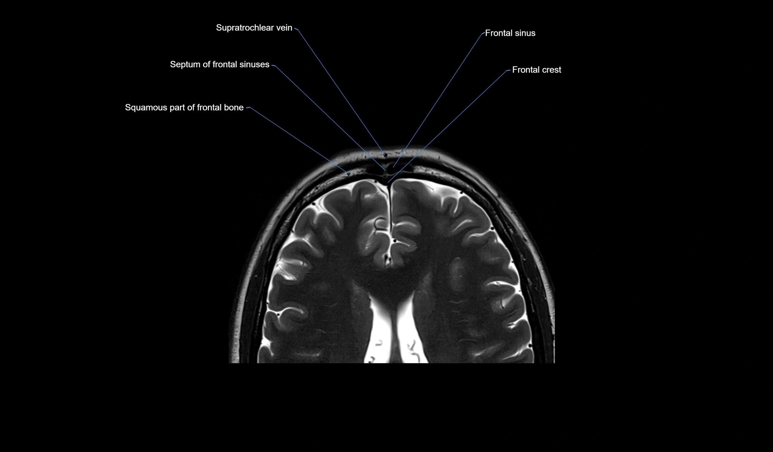 MRI face & paranasal sinuses(PNS) labelled  axial  cross sectional anatomy 3T radiology  image -00034.webp